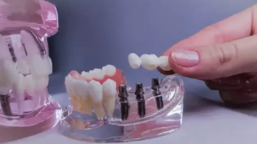 What is the Cost of a Dental Bridge?